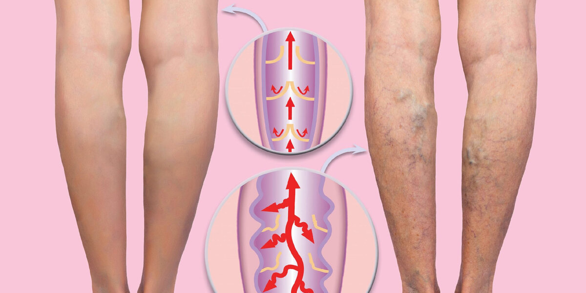 Ursachen von Krampfadern