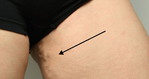 Erweiterte Vene an der Innenseite des Oberschenkels