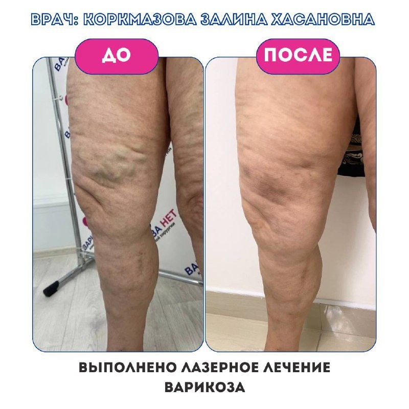 Laserbehandlung Varizen