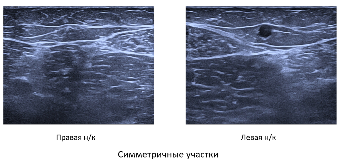 Ultraschallbild vor und nach Venenbehandlung