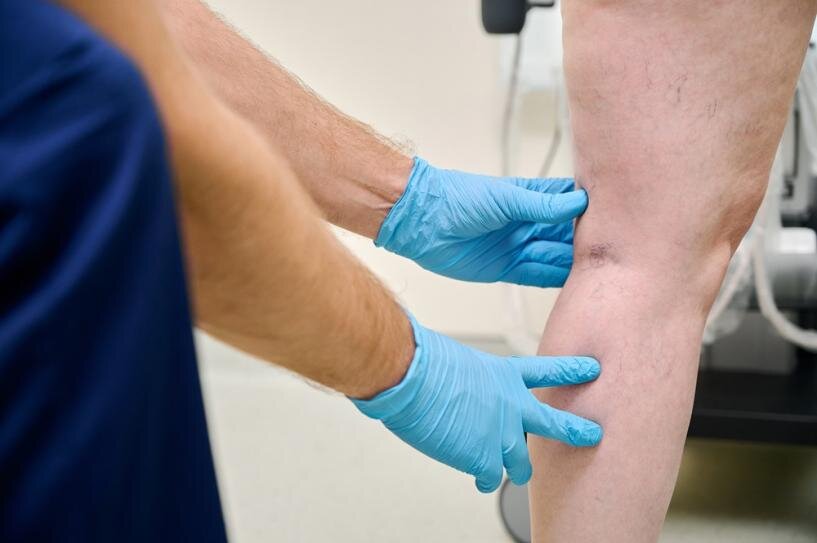 Arzt bei der Untersuchung von Krampfadern für Radiofrequenzablation