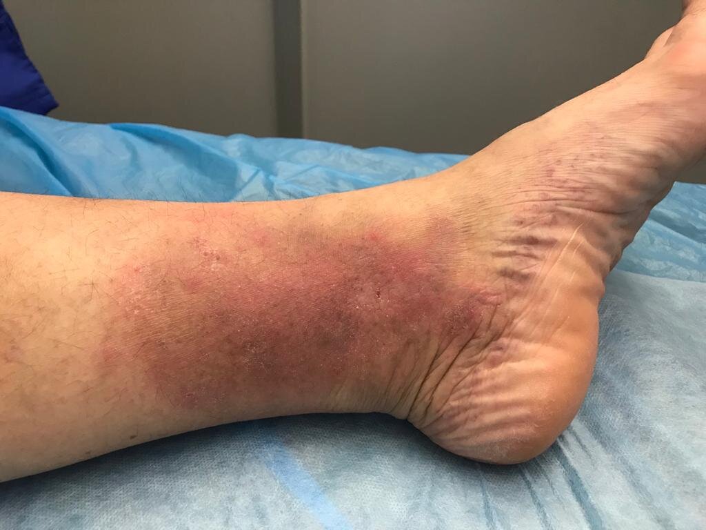 Der Zustand der Patientin hat sich verbessert, aber die Pigmentierung ist leider irreversibel. Zögern Sie nicht, konsultieren Sie einen Phlebologen, wenn Sie störende Veränderungen oder Empfindungen in Ihren Beinen bemerken. Foto: Phlebologie-Zentrum.