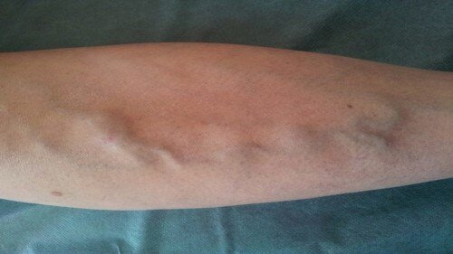 Beratung beim Phlebologen zur Behandlung von Krampfadern