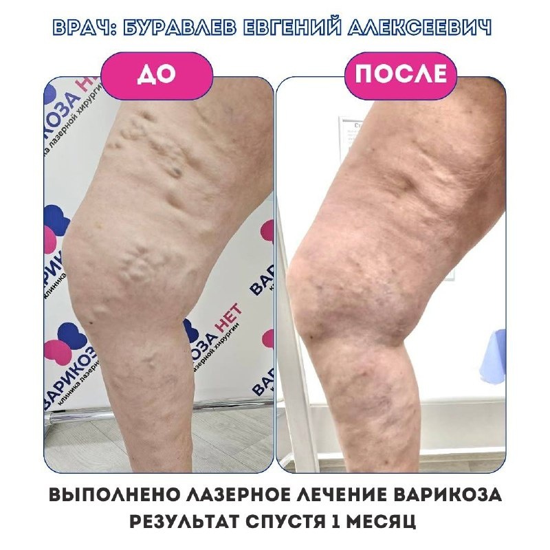 Sklerotherapie Ablauf