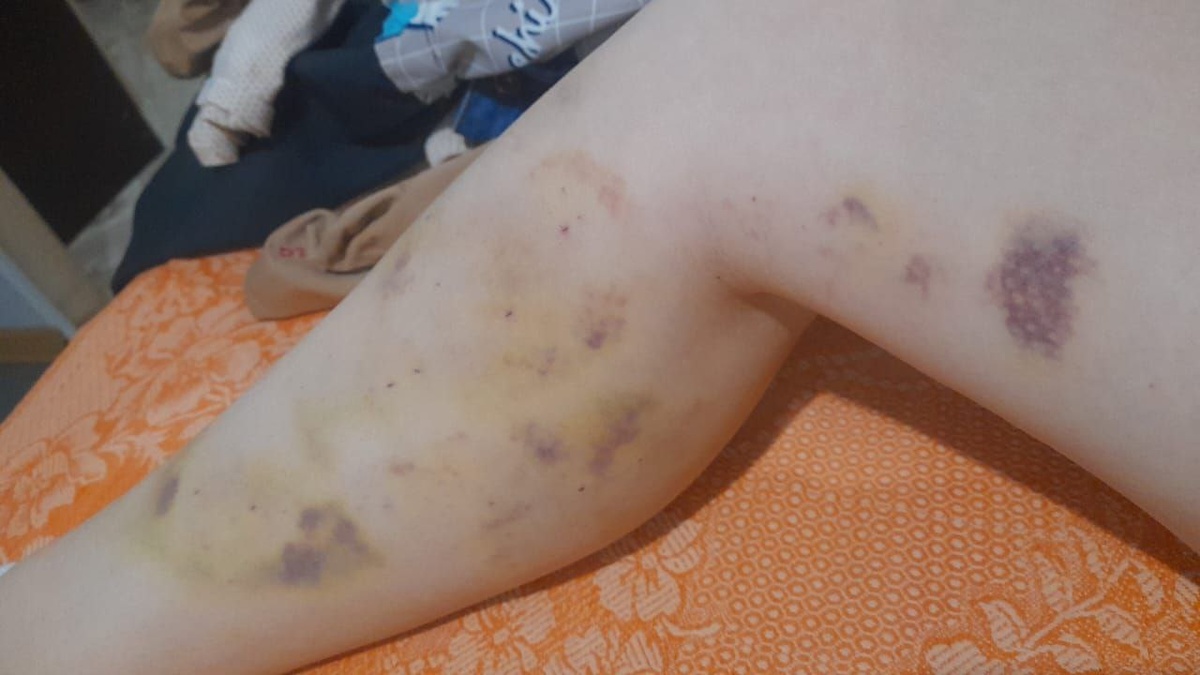 Blutergüsse nach der OP