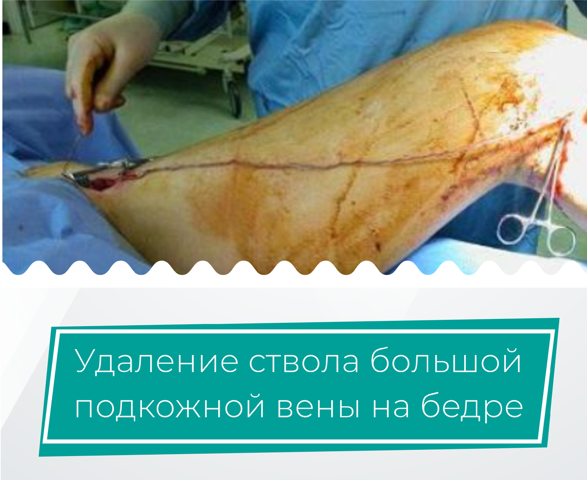 Entfernung des Stammes der großen Rosenvene am Oberschenkel