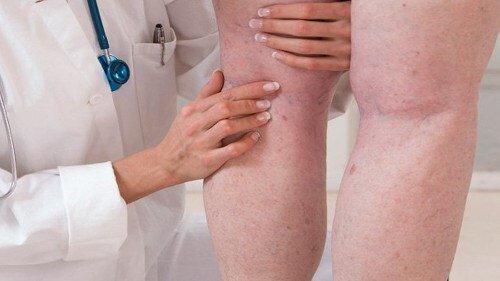 Erste Anzeichen von Krampfadern an den Beinen