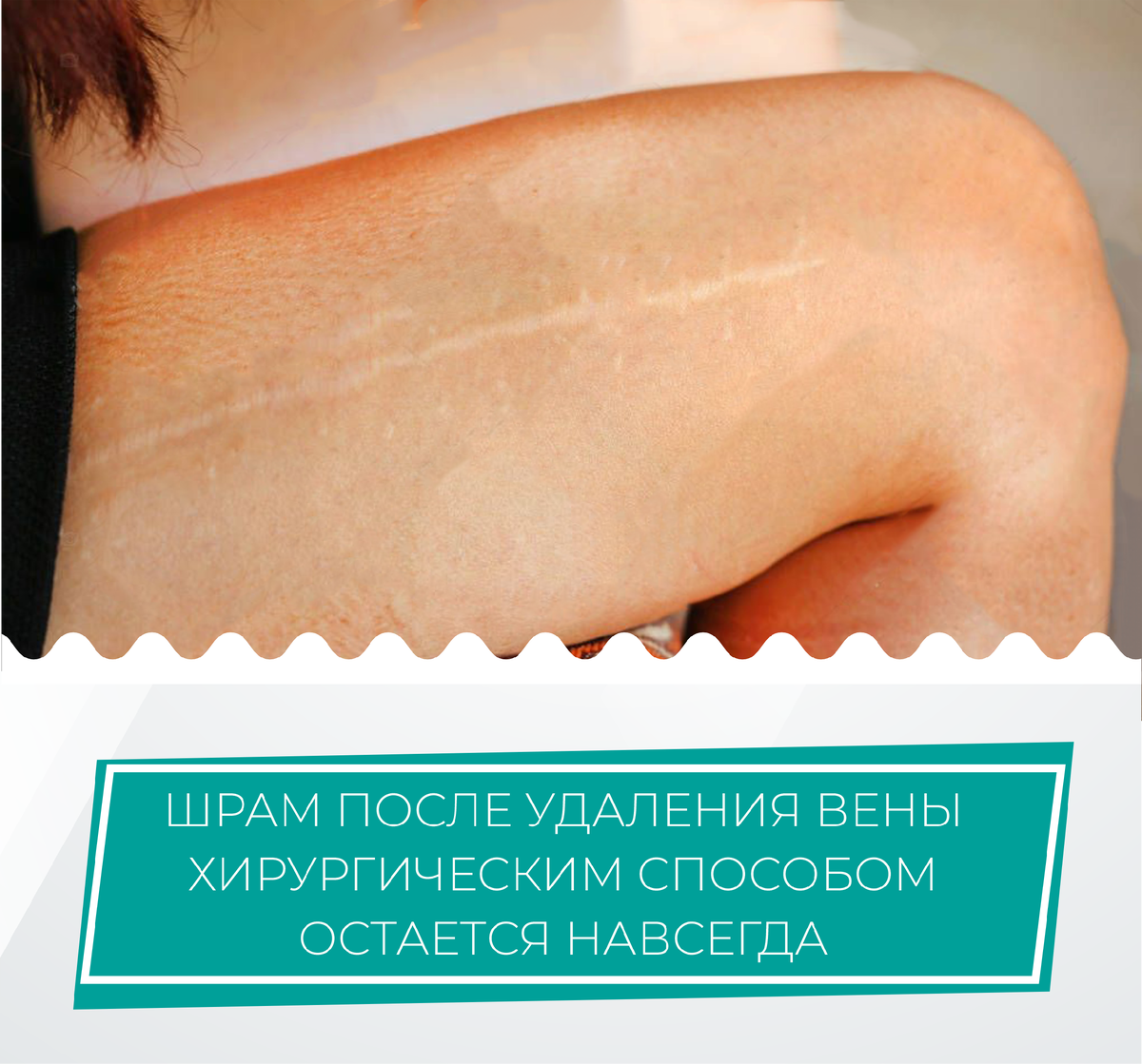 Beispiel einer Narbe an der Innenseite des Oberschenkels nach einer offenen Venenoperation