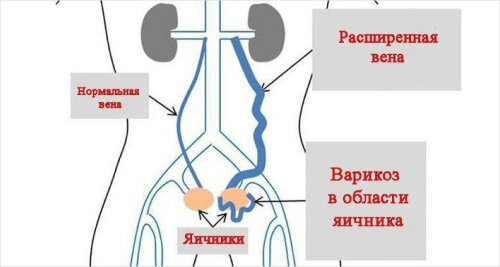 Schema der männlichen Organe und betroffene Venen