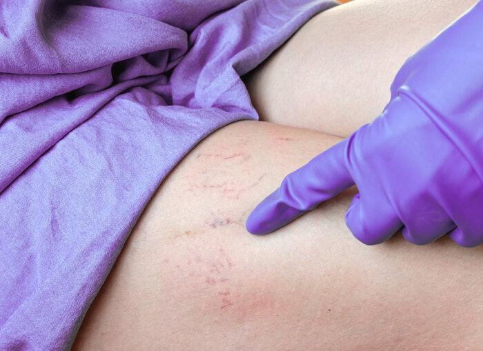 Venenbehandlung und gesunde Beine