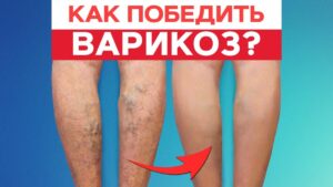 Krampfadern behandeln: Ursachen, Symptome und natürliche Methoden ohne Operation