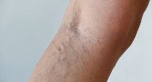 Krampfadern Stadien: Folgen, Risiken und Behandlungsmöglichkeiten