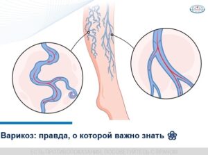 Krampfadern behandeln: Symptome, Ursachen und moderne Lasertherapie