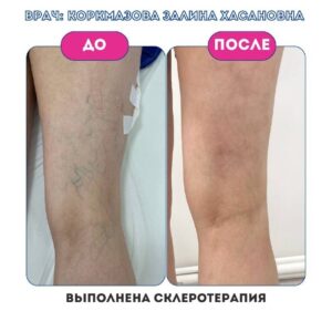 Behandlung von Krampfadern: Sklerotherapie und Lasertherapie im Vergleich