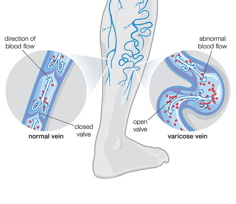 Behandlung und Vermeidung von Krampfadern