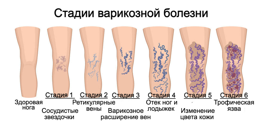 Стадии варикозной болезни