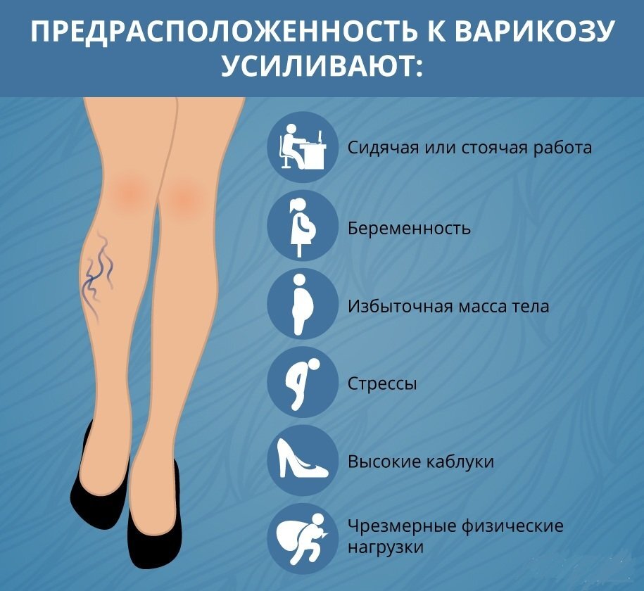 Veranlagung für Krampfadern