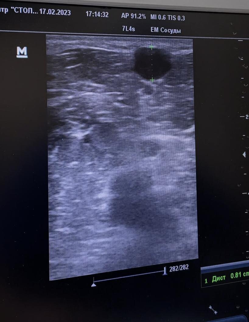 Erweiterung der saphenopoplitealen Mündung und massive Erweiterung der Vena saphena parva