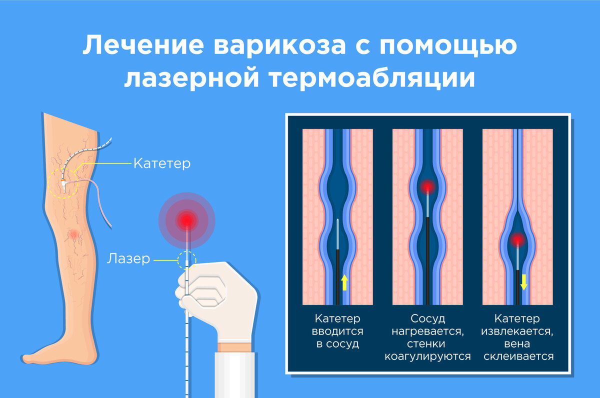 Krampfaderbehandlung mit Laser-Thermoablation