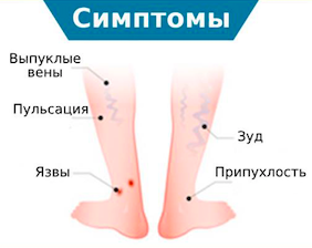 Симптомы варикозной болезни