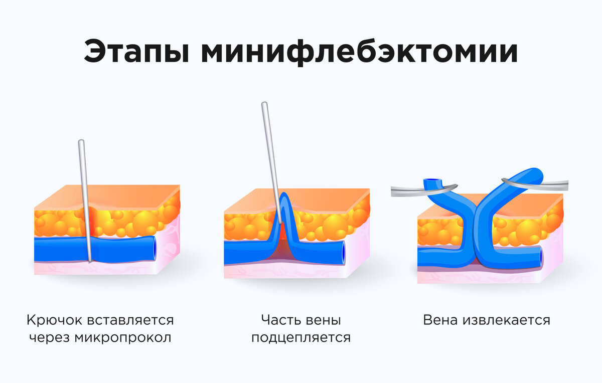 Phasen der Miniphlebektomie