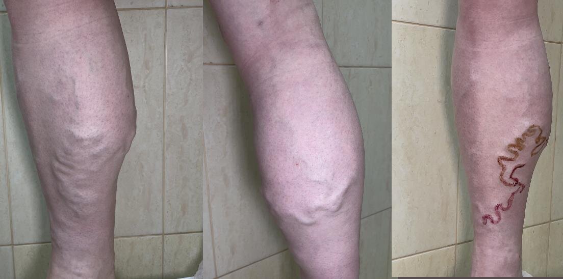 Zustand der Beine vor der Operation