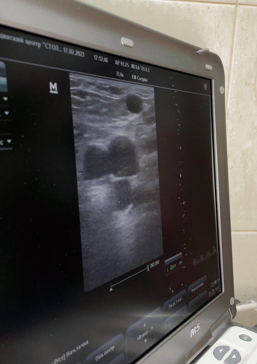 Erweiterung des Stammvenenstamms