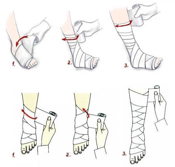 Verschiedene Bandagierungsschemata für Beine mit der elastischen Tens-Binde