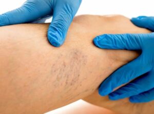 Krampfadern und Wehrdienst: Was Rekruten wissen müssen