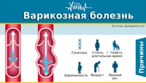 Alles über Krampfadern: Ursachen, Symptome und moderne Behandlungsmethoden