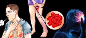 Thrombose erkennen und richtig handeln: Ein lebensrettender Leitfaden