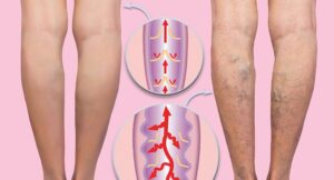Warum die Krampfadern Behandlung oft fehlschlägt und was Sie darüber wissen müssen
