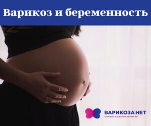 Krampfadern in der Schwangerschaft: Ursachen, Gefahren und Behandlung
