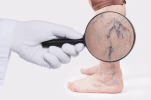 Krampfadern: Ursachen, Symptome und moderne Behandlungsmethoden